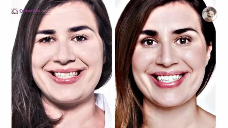 Consensus med – Juvederm i botoks – kwas i toksyna na zmarszczki i migrenę!