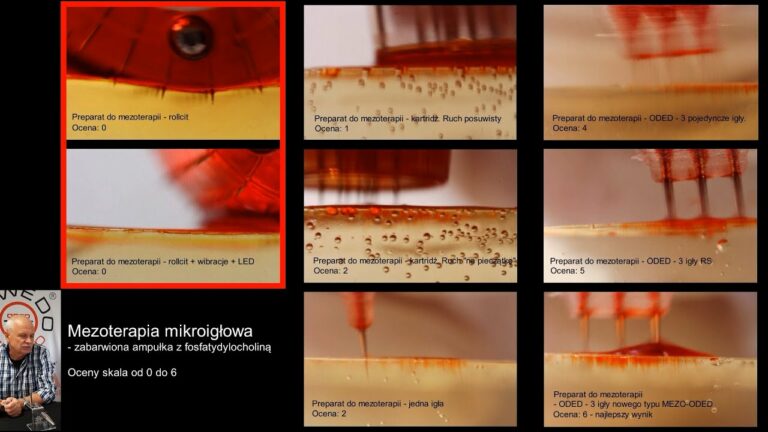 KIEDY MEZOTERAPIA MIKROIGŁOWA DZIAŁA I JAK JĄ WYKONAĆ ŻEBY NIE BYŁA PSEUDO ZABIEGIEM?