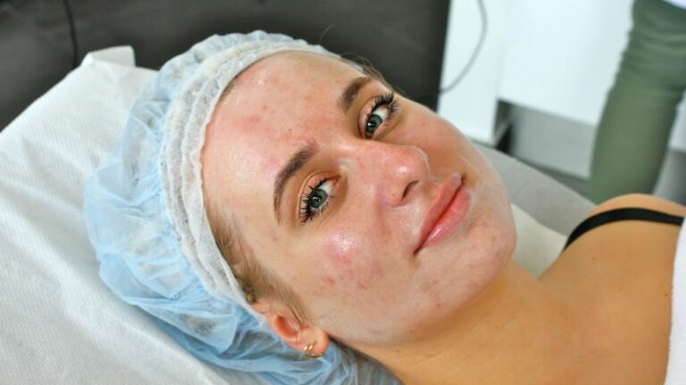 PEELING CHEMICZNY, KWASY: DERMATOLOG ODPOWIADA