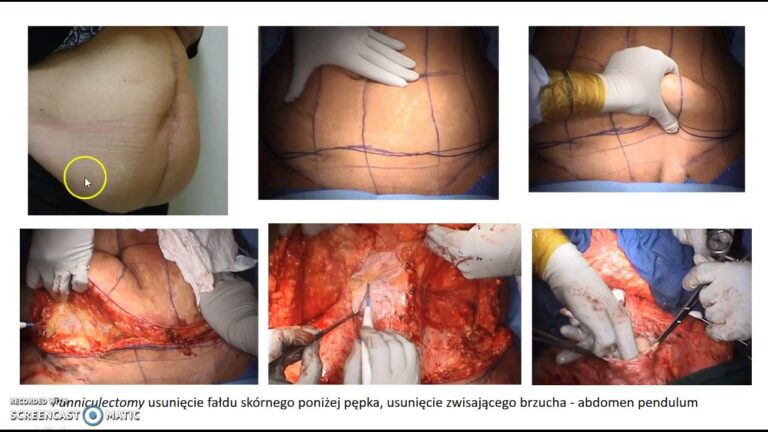 Plastyka ściany brzucha przy operacji przepukliny #1