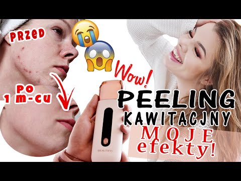 TO NIE FEJK! PEELING KAWITACYJNY Jak używać? Co daje? Czy warto? Efekty po miesiącu!