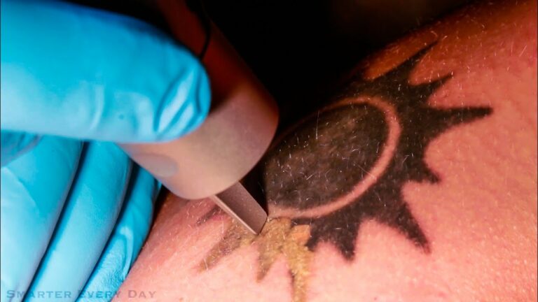 How Laser Tattoo Removal Works – Smarter Every Day 123