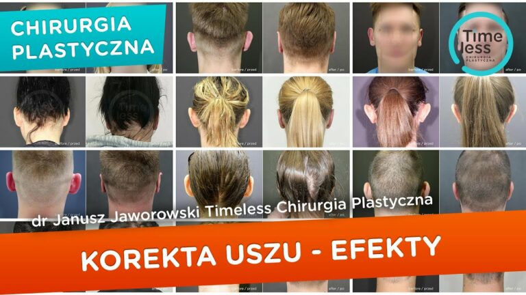 #Korekcjauszu – efekty po zabiegach korekty uszu