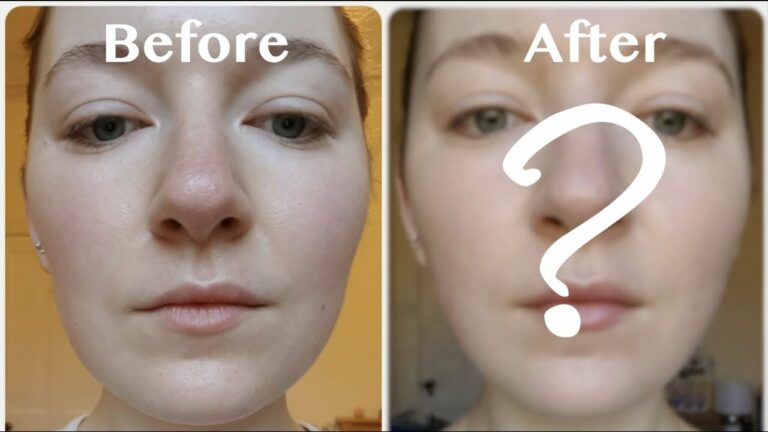 My Face After 2 Months Of V-Shape Face Massage – Did It Work?