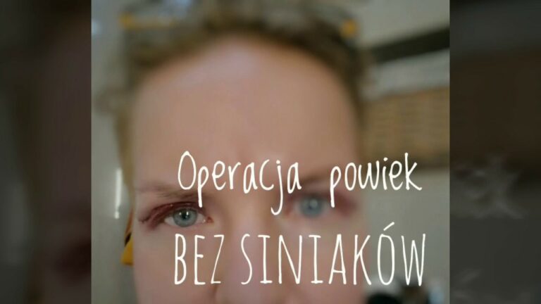 Operacja powiek bez siniaków