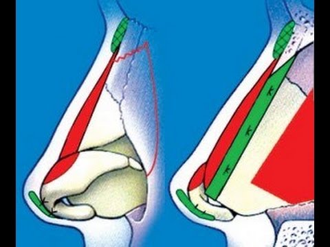 PLASTYKA NOSA SYN  RYNOPLASTYKA, KOREKCJA NOSA
