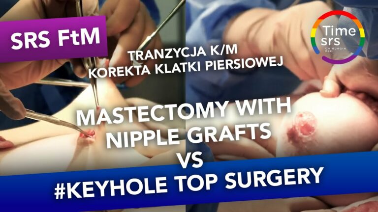 #Tranzycja K/M korekta klatki piersiowej – FtM #keyhole top surgery VS mastectomy with nipple grafts