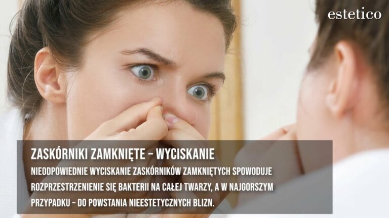 Zaskórniki zamknięte – skąd się biorą i czy można pozbyć się ich raz na zawsze?