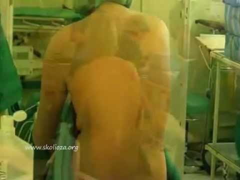 Znieczulenie zewnątrzoponowe_scoliosis_anaesthesia_www.skolioza.org_