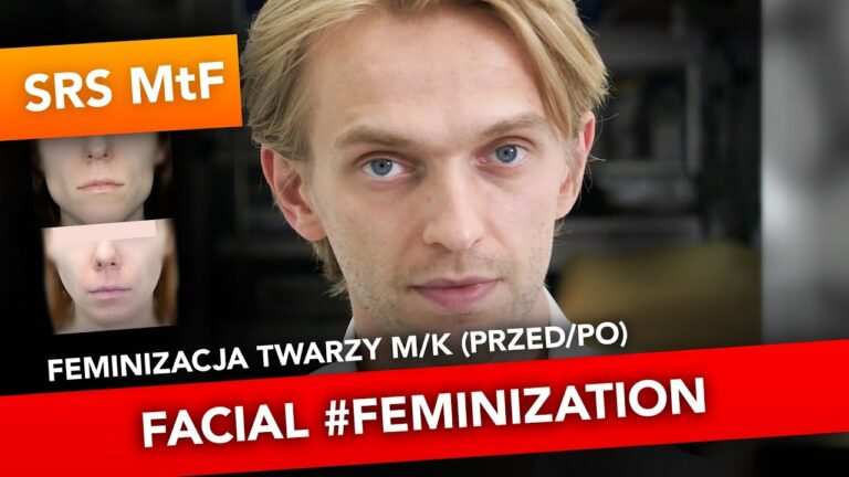 #FFS feminizacja twarzy przed/po, facial #Feminization before/after – dr n.med. Maciej Mazurek