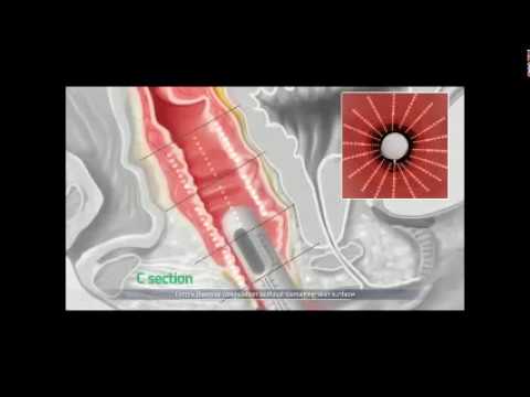 HIFU VagiTight  dla ginekologii plastycznej