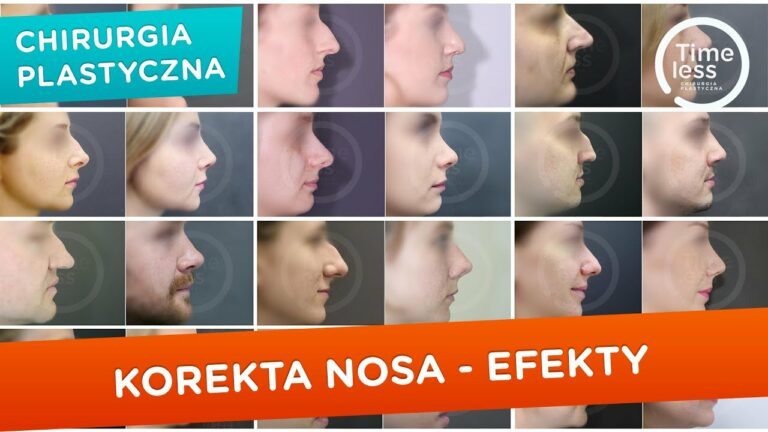 #Korekcjanosa, #rhinoplastyka – efekty po zabiegach korekty nosa