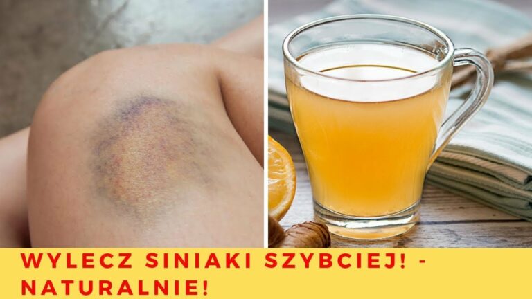 Jak pozbyć się siniaków naturalnymi sposobami – Wylecz siniaki szybciej!