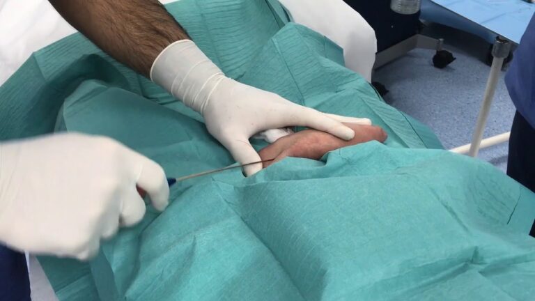 Powiększenie penisa autologicznym przeszczepem tłuszczu w Chiroplastica – penile enlargement