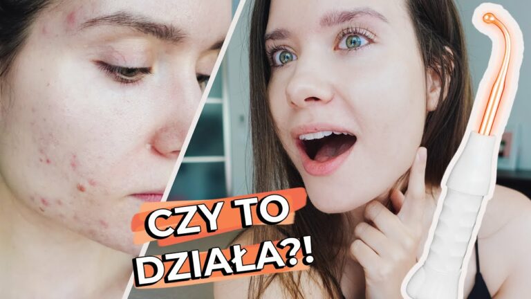 Prądy d'Arsonvala na TRĄDZIK – Czy To Działa? | Test na żywo | Przed i po