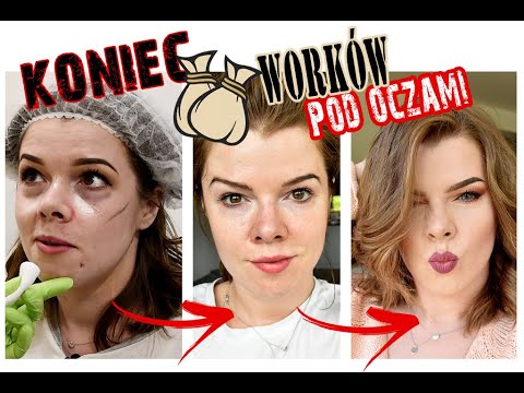 SZOKUJĄCA ZMIANA! KONIEC z Workami pod oczami! Nareszcie