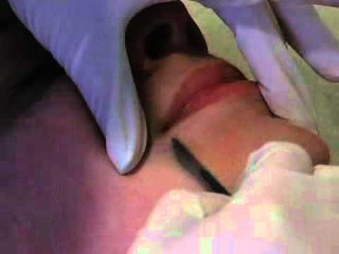 Dermaplaning procedure by Thrive Med Spa in Chicago