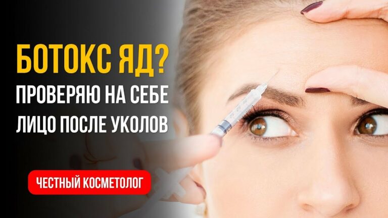 БОТОКС ЯД? ОТЗЫВ после УКОЛОВ ВСЕГО ЛИЦА. Диспорт, Ксеомин вся правда.