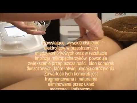 BEAUTIFULSKIN – ZABIEG LIPOKAWITACJI