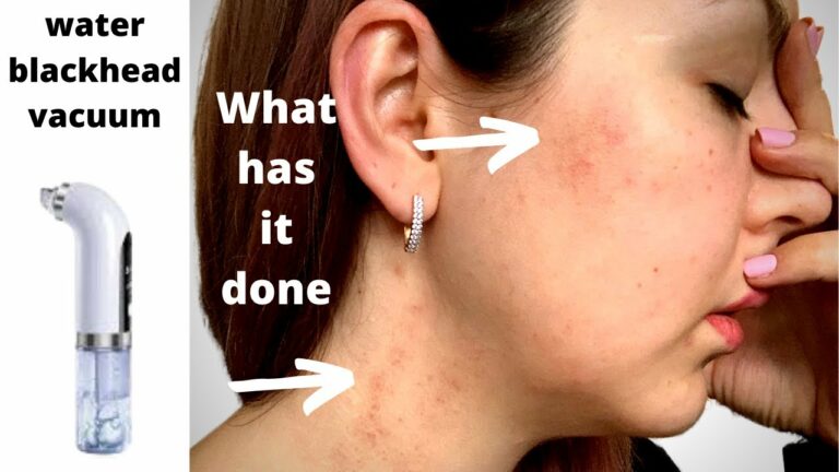 Blackhead vacuum remover/How it works and what it has done to my face