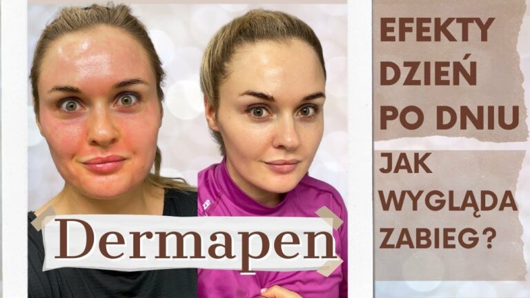 🔥DERMAPEN🔥 (mezoterapia mikroigłowa) – JAK WYGLĄDA ZABIEG || EFEKTY (dzień po dniu)