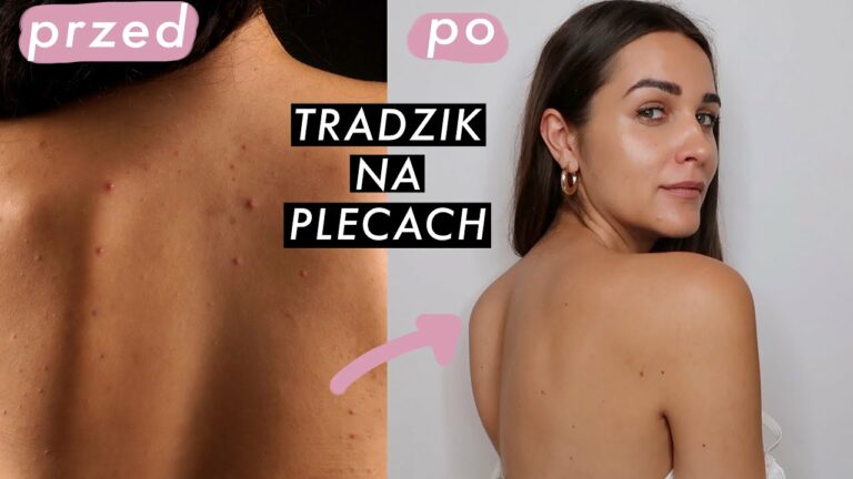 JAK POZBYĆ SIĘ TRĄDZIKU NA PLECACH? | najlepsze kosmetyki