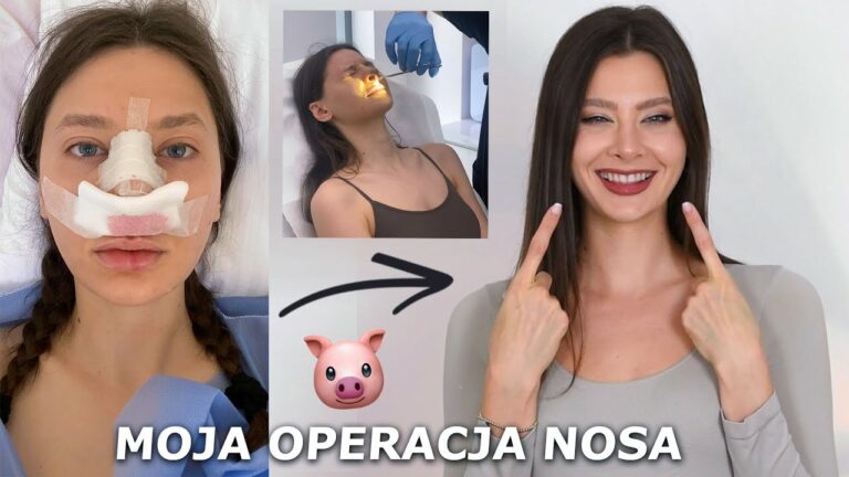 MOJA OPERACJA PLASTYCZNA NOSA 👃🏻