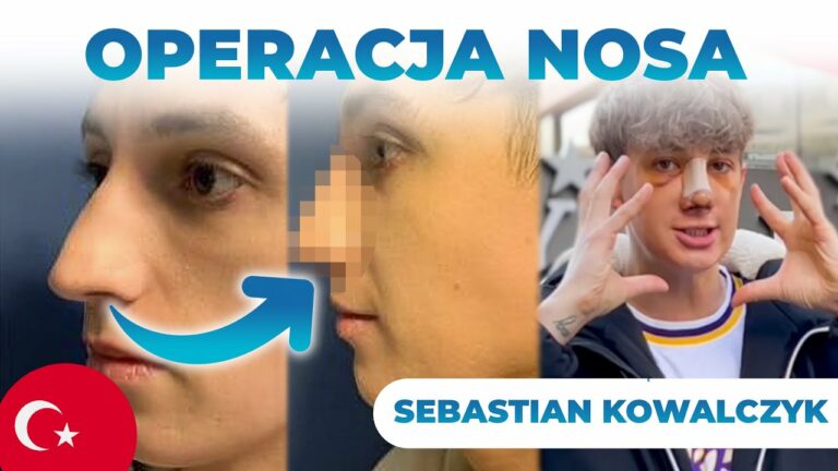 Operacja Nosa w Turcji | TikToker Sebastian Kowalczyk *Reakcja na nowy nos 👃*