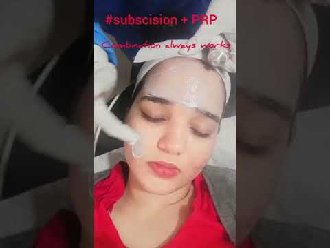 Acne scar Treatment with combination of Subcision & PRP ( Metamorphosis Clinic )