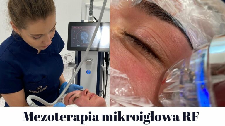 Mezoterapia mikroigłowa RF || Secret, Infini – najskuteczniejsze spłycenie zmarszczek?