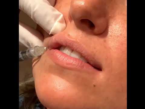 Boost Lip Volume | Lip Filler Beverly Hills Profiles