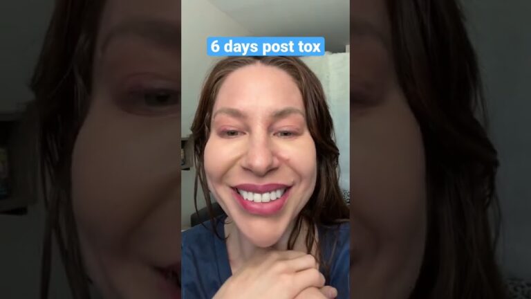 DIY Botox results