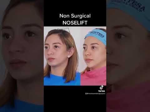 FACIAL CONTOURING, NOSE LIFT, CHIN AUGMENTATION, CHEEK AUGMENTATION AT MONTESA MEDICAL GROUP