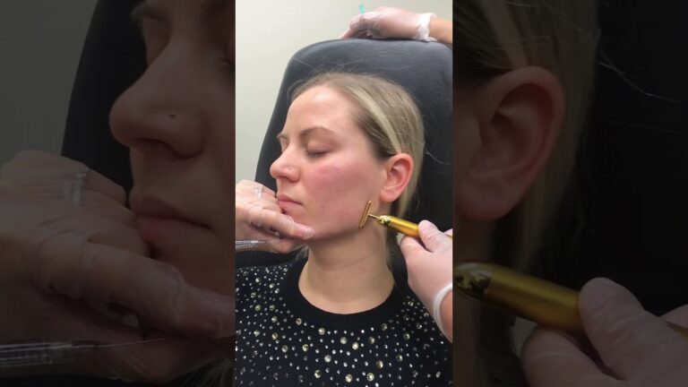 Jawline Filler Injection Technique by Dr. Tina Ho