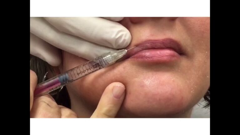 Lip Enhancement with Dr. Carlos Wolf