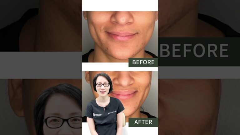 Lip Filler Before & Afters | Dr. Melissa Chiang creates natural looking beautiful lips