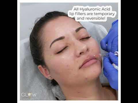 Lip & Chin Filler Treatment (Juvederm Ultra Plus) – Glow Aesthetic Center