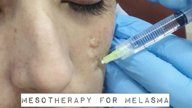 Mesotherapy Melasma Treatment