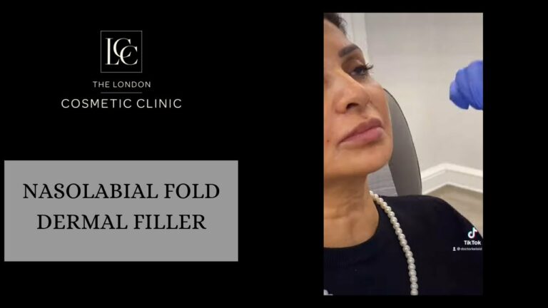 Nasolabial Fold Dermal Filler Treatment By Dr Salinda Johnson