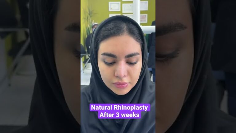 Natural Rhinoplasty after 3 weeks