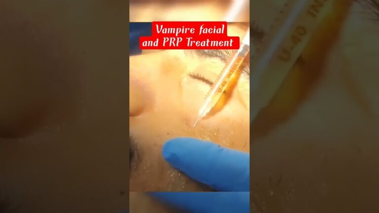 Vampire Facial and PRP treatment