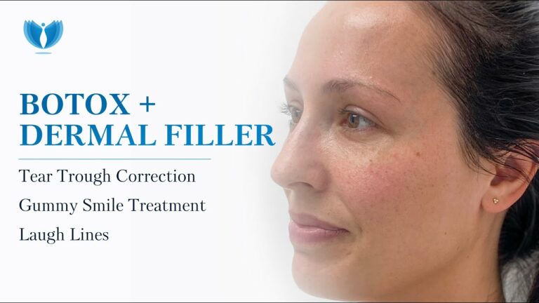 What Botox and Dermal Filler Can Do for You – Tear Trough Treatment, Gummy Smile, Laugh Line