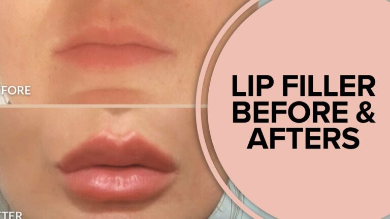 Youth Haus Medspa Los Angeles: Lip Filler Injections Before and After