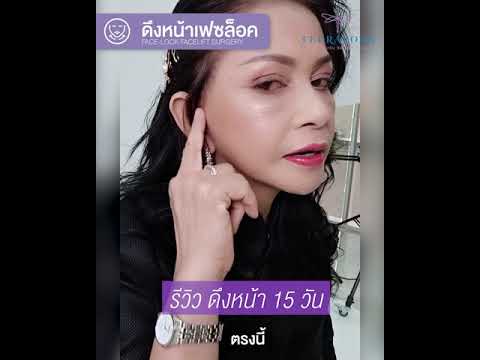 รีวิวดึงหน้า Facelift เฟซล็อคอายุ 64 ปี จากพี่ กชามาศ บินมาไกลจากประเทศเนเธอร์แลนด์ ธีรพรคลีนิก