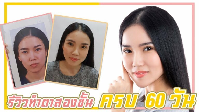 #รีวิวตาสองชั้น 60 วัน ที่ธีรพรคลินิก👍 หมอชลธิศ