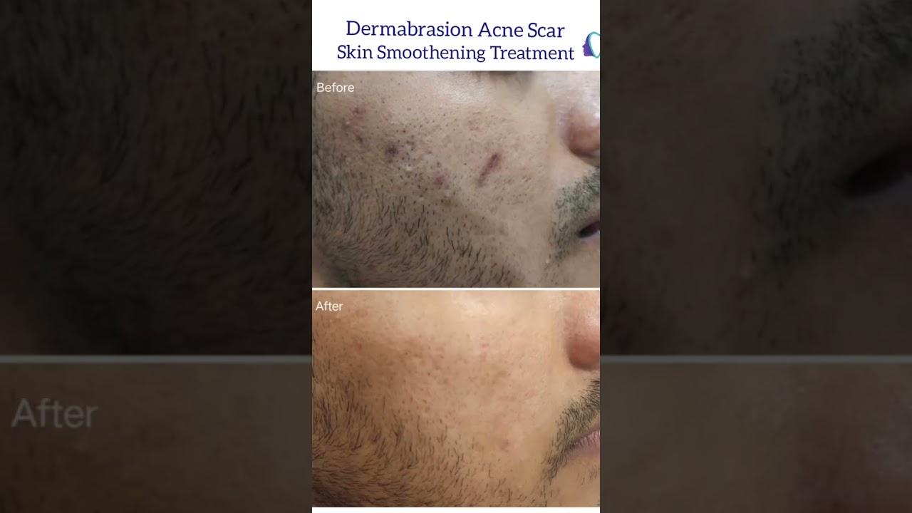 Dermabrasion Skin Smoothening Resurfacing for scars #glowingskin