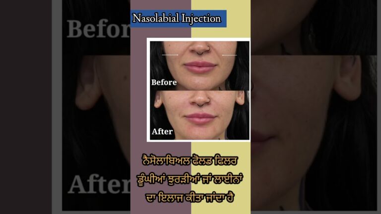 Nasolabial Fold Filler injection Treatment