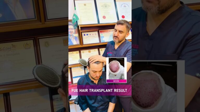 Transformative Hair Transplant Results Live || Dr. Habib Ullah Shah